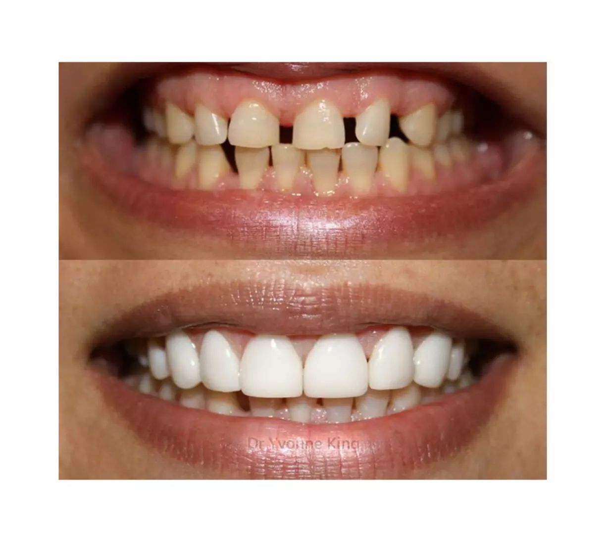 Before and after pictures of our cosmetic dental treatments