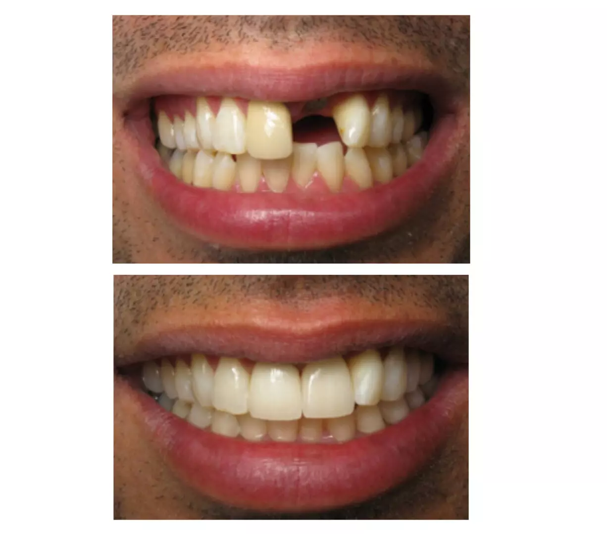 Before and after photos of our dental implant services